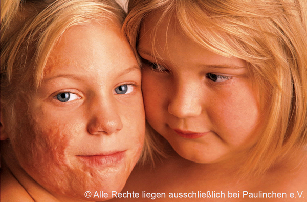 ©Paulinchen e. V. - Initiative für brandverletzte Kinder